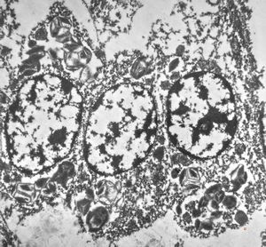 bone marrow … plasmocytoma (parafin-embedded sample) bone marrow … plasmocytoma (parafin-embedded sample)